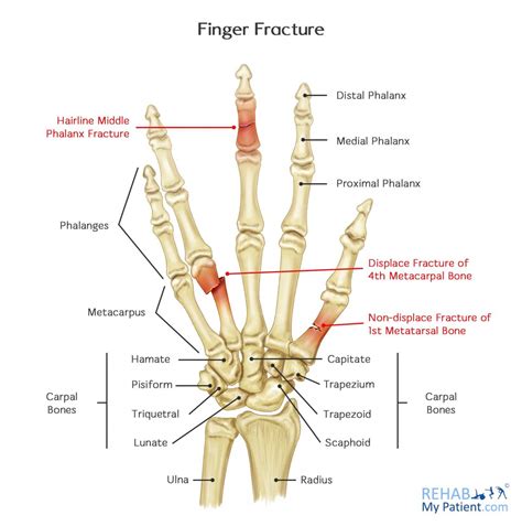 620D subsequent encounter for fracture with routine healing. . Icd 10 fracture finger